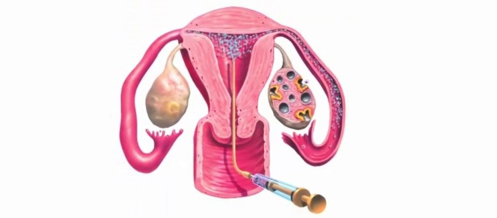 Understanding the working of IUI